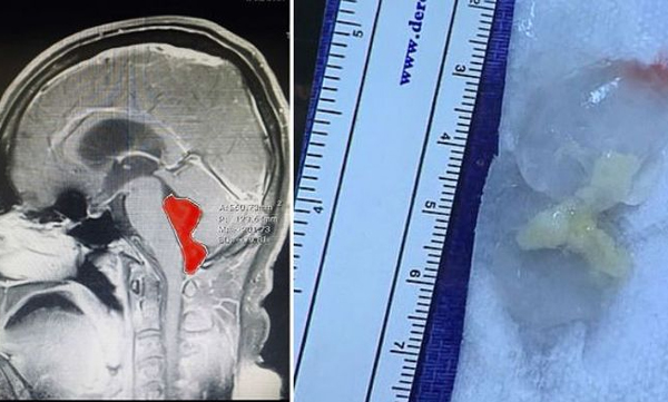 doctors removed from tape worm from human brain 