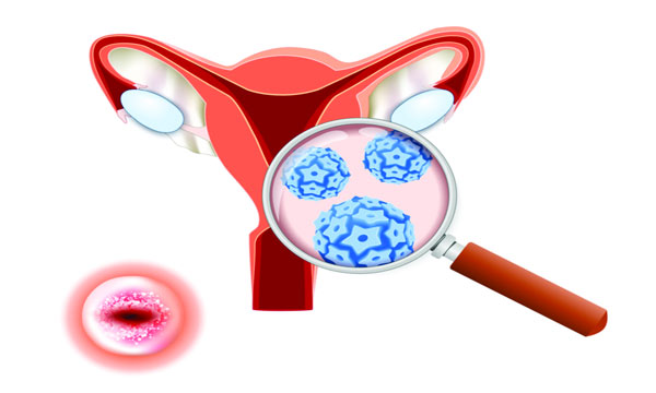 cervical cancer