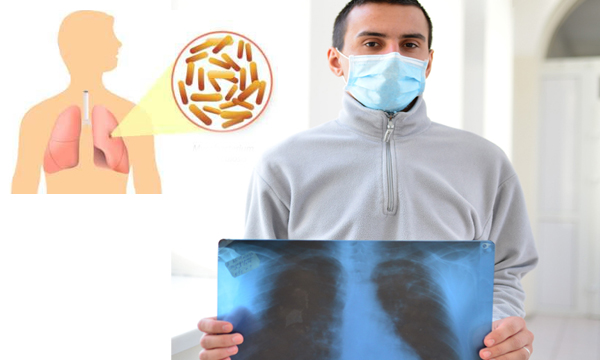 tb symptoms and treatment