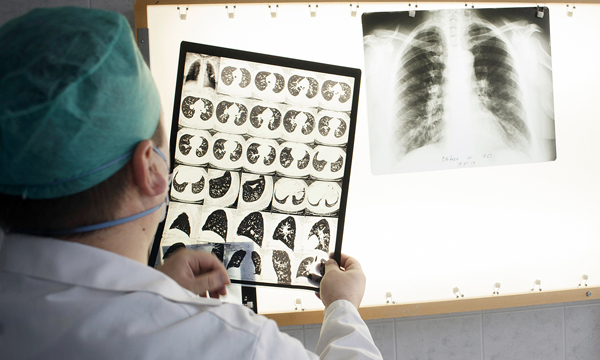 tb symptoms and treatment