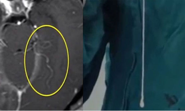 headaches, doctors find 6 inch live worm in brain