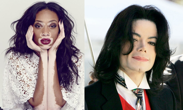 june 25 world vitiligo day michael jackson chantelle brown young
