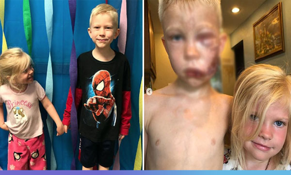 6-Year-Old Who Saved His Sister from Dog Attack and Got 90 Stitches is Internet's New Superhero