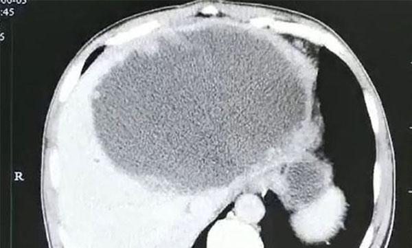 eggs of parasites inside mans liver