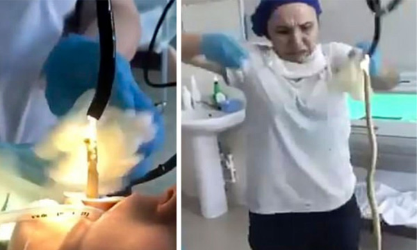 snake taken from womens stomach through surgery 