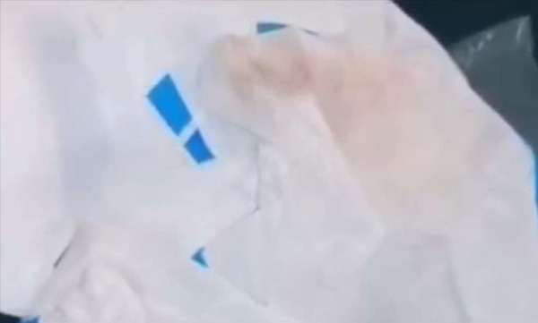 found blood stain in ppe kit given to pariyaram medical college 
