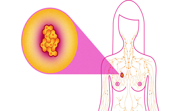 breast cancer symptoms diagnosis and treatment