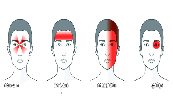 migraine symptoms treatment