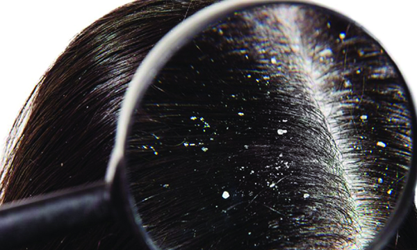 dandruff ayurvedic treatment