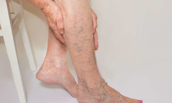 varicose veins symptoms and treatment