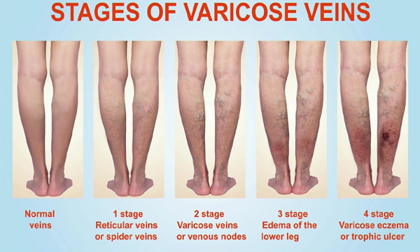 varicose veins symptoms and treatment