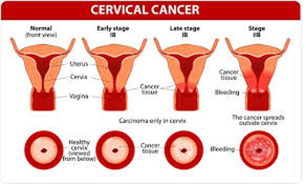 world cervical cancer day