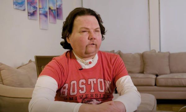 Worlds first face transplant operation 