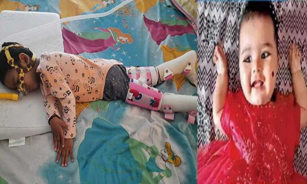 Spinal muscular atrophy, Rs 22 crore for treating 2 children