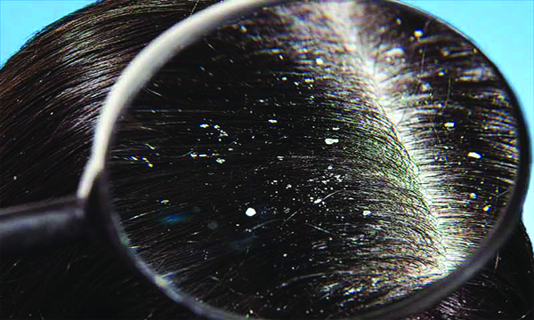 Ayurvedic treatment for dandruff and hoar