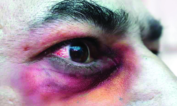 black fungus symptoms and treatment