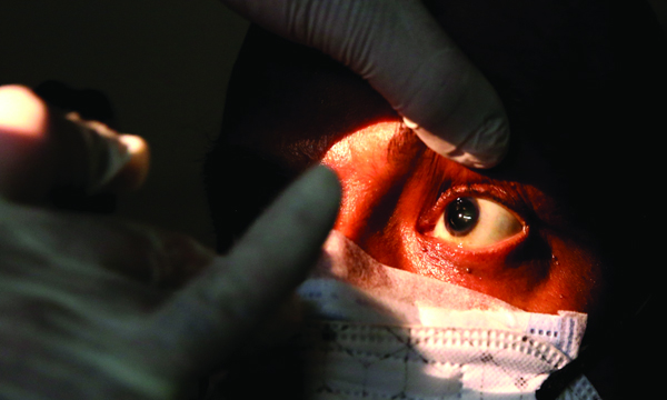 black fungus symptoms and treatment