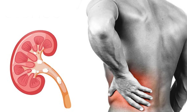 kidney stone symptoms and treatment