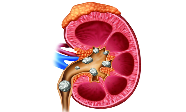 kidney stone symptoms and treatment