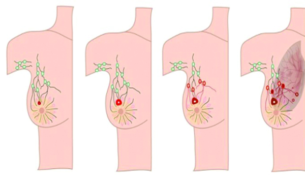 breast cancer symptoms and treatments