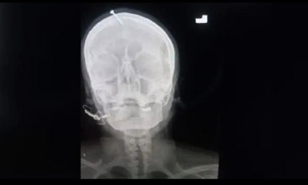 faith-healer-hammered-nail-into-pregnant-womans-head-in-pakistan