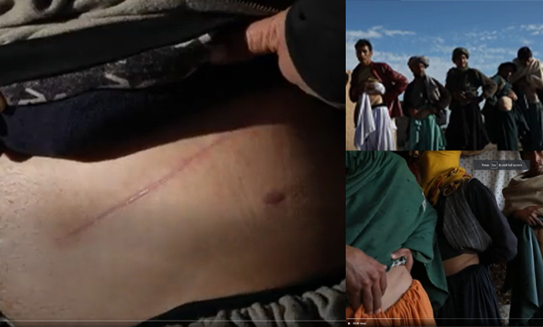 Starvation increases in Afgan results in kidney selling