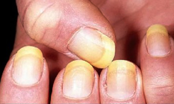 color-changes-in-nail-may-be-the-sign-of-some-health-problems