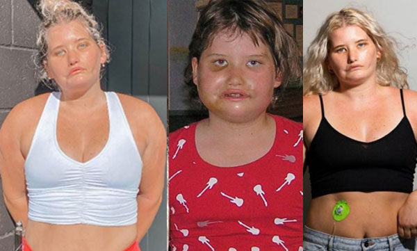 tayla-clement-with-moebius-syndrome-model-for-international-brand