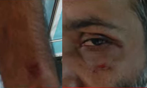 man attacked by fox in mundakkayam