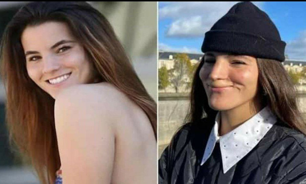 Pitbull Bites Model; The upper lip was completely lost in the attack