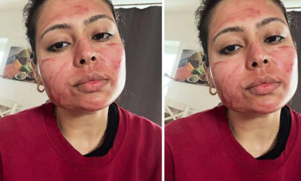 Blood Viral Prescription for Skin Care