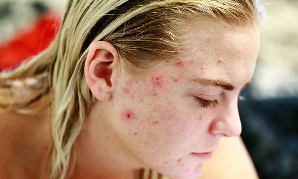 Avoid these foods to fight pimples