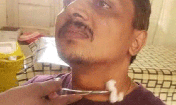 Biker Injured In Accident Caused By Cable kochi