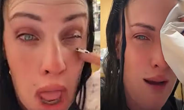 Instead of drops, superglue was poured into the eye and the eyelashes stuck. Young woman shares her experience