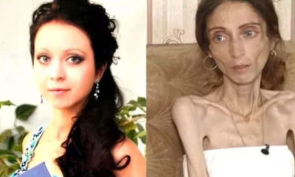 The husband constantly mocked him for the wood. The young woman who lost 22 kg is now in the hospital, and then her husband abandoned her!