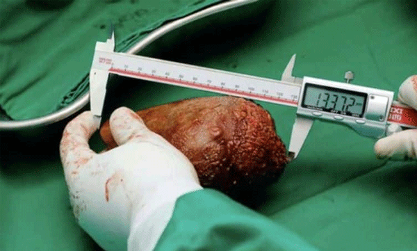 Largest ever seen: Guinness World Record urine stone