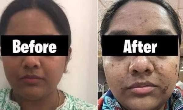 Rs 17,500 hydra facial done, face burnt later, police files case against salon owner