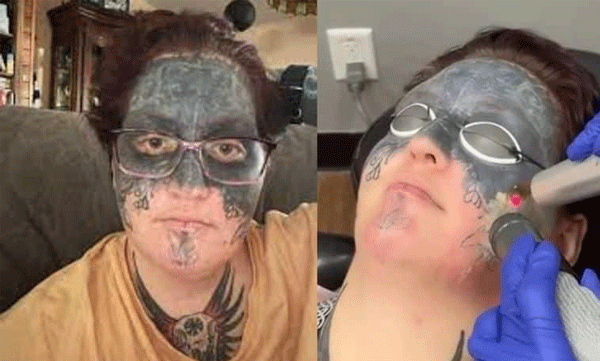 Face tattooed after being drugged unconscious: Woman relieved of boyfriend's brutality
