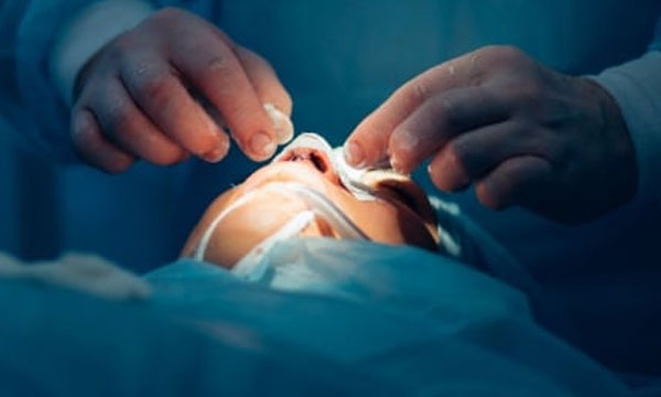 Helping criminals 'makeover' through plastic surgery
