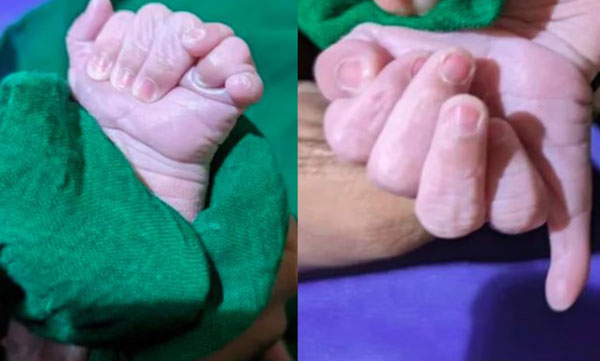 baby-born-with-13-fingers-and-12-toes-in-karnataka-family-sees-divine-blessing