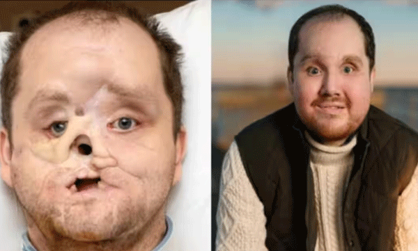 face-of-a-us-youth-who-was-crushed-in-a-suicide-attempt-has-been-successfully-reconstructed-after-10-years
