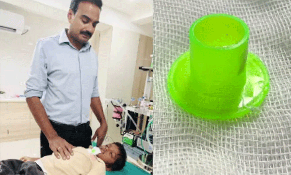 plastic-pellet-found-from-6-year-old-boys-throat-after-a-year-of-throat-pain