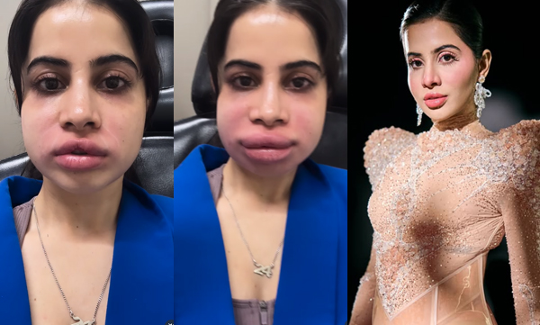 urfi-javed-lip-filler-removal