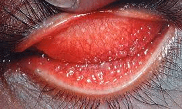 fiji-26th-country-to-eliminate-the-disease-trachoma-as-public-health-problem