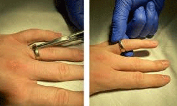 ring-stuck-in-finger-trauma-care-team-removed-ring-safely