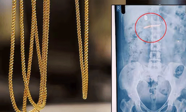 \gold-chain-stole-and-swallowed-accused-woman-shifted-to-kozhikode-medical-college-hospital-efforts-to-recover-the-gold-