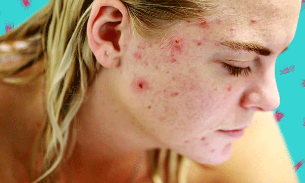 pimple-face-problems