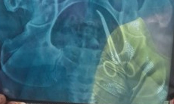 Scissors forgotten in housewife's stomach removed; surgery to be performed soon at Amrutha