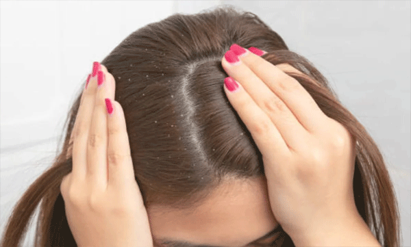 the-bald-truth-why-shaving-your-head-wont-cure-dandruff