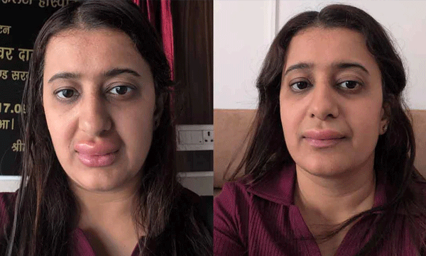 vande-bharat-food-allergy-report-woman-viral-post